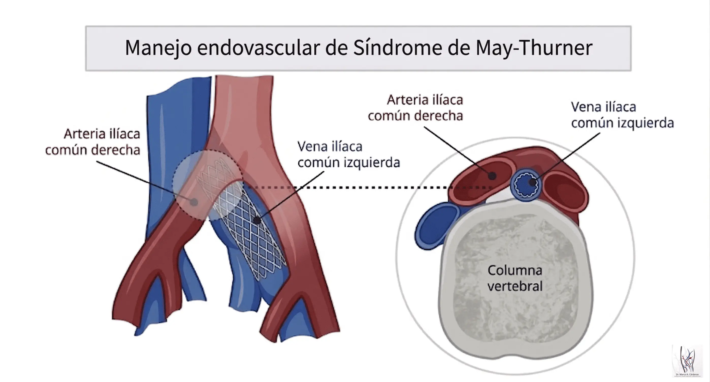 Stent May-Thurner
